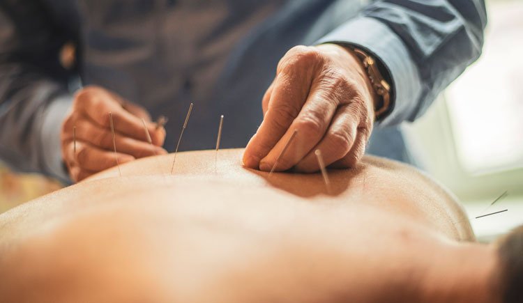 acupuncture